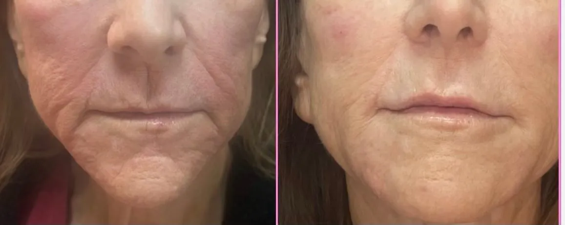 Injectable Fillers - Restoring Volume Before and After